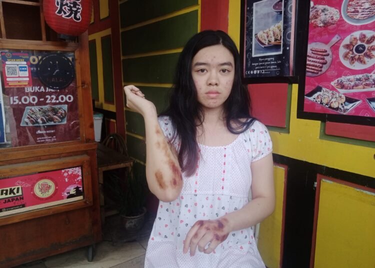 HP Dicuri Saat Layani Pembeli, Penjual Takoyaki di Cibinong Alami Luka Usai Terseret Motor Pencuri