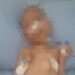 Tak Dapat Bantuan Pemerintah, Anak Penderita Gizi Buruk di Parungpanjang Meninggal