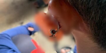 Kail Pancing Nyangkut ke Telinga, Bocah di Cibinong Dievakuasi Damkar